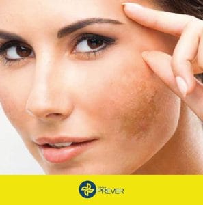 Você sabe oque é Melasma?